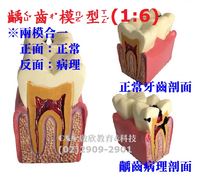 【牙齒】模型 1:6「超大型」 齲齒病理-解剖說明 **2模合一**