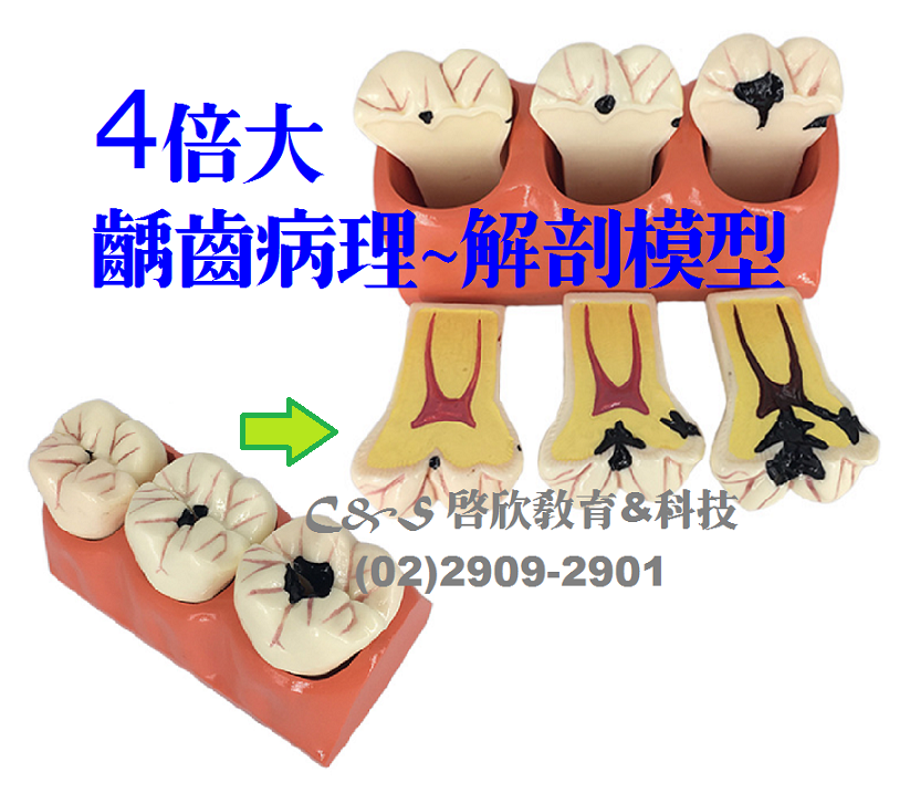 【牙齒】模型 1:4「超大型」 齲齒病理-解剖說明 可取出+解剖面 **3模合一**
