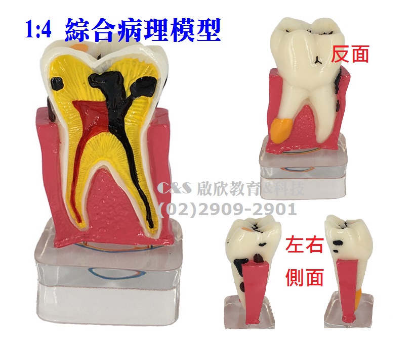 【牙齒】模型 1:4 綜合病理 4倍大 帶神經